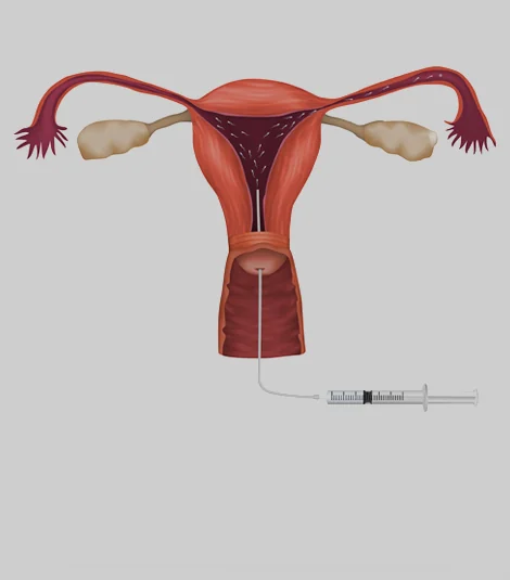 인공수정 안내 그림