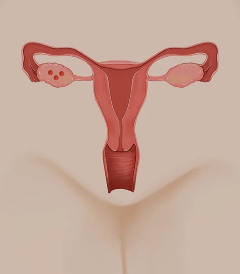 다낭성난소증후군 안내 그림