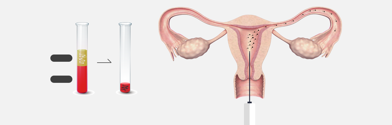 정액을 특수 처리한 뒤 관으로 자궁 안에 정자를 주입하는 과정